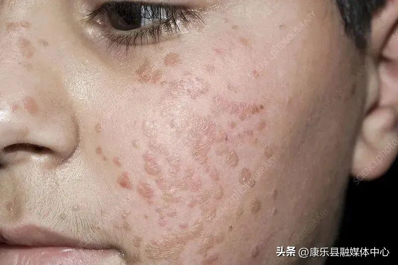 身上長了HPV，我們該如何面對與處理